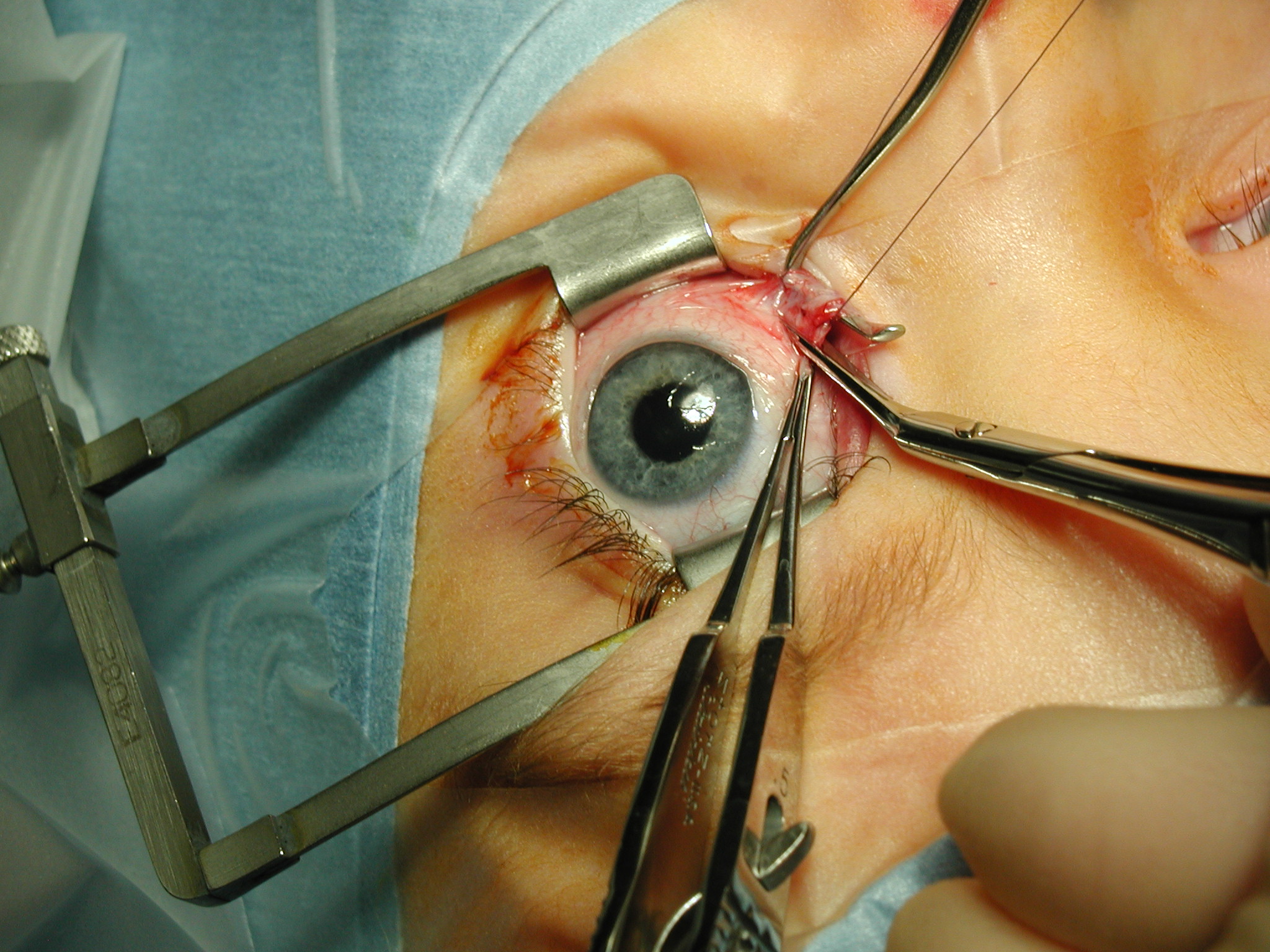 Medical procedure involving corrective strabismus eye surgery